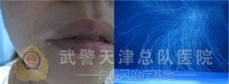 【治疗前,玲玲嘴角,头部白斑很明显,黑色素脱失严重】